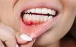 جایگزین طبیعی آنتی‌بیوتیک برای درمان بیماری شدید لثه